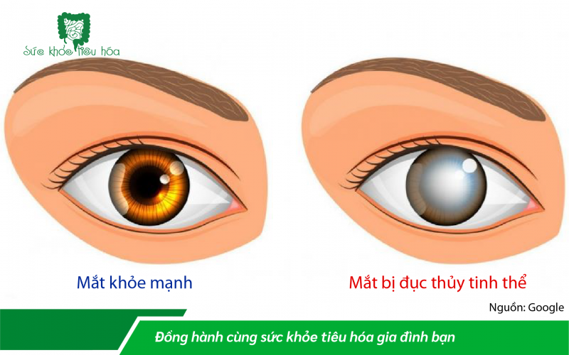 BỆNH ĐỤC THỦY TINH THỂ MẮT (CATARACTE)