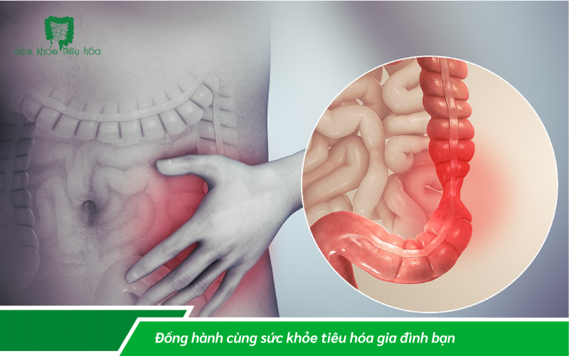 KIẾN THỨC THÔNG THƯỜNG CẦN BIẾT VỀ HỘI CHỨNG RUỘT KÍCH THÍCH!