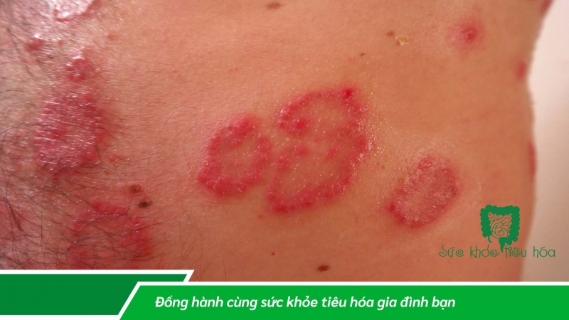 LỢI ÍCH CỦA LACTOBACILLUS PLANTARUM ĐỐI VỚI SỨC KHỎE