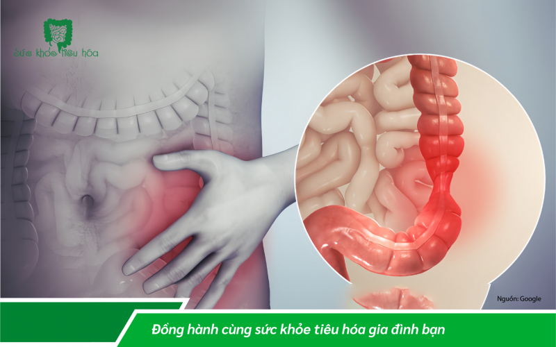 MEN VI SINH PROBIOTICS CHỐNG LẠI RỐI LOẠN TIÊU HÓA DO KÍCH THÍCH RUỘT SAU TẾT