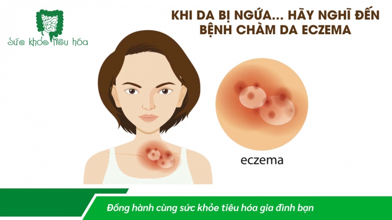 MEN VI SINH PROBIOTICS ĐIỀU TRỊ BỆNH CHÀM DA ECZEMA Ở BÀ MẸ & TRẺ EM