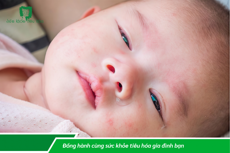 TRẺ SINH NON, SINH MỔ CÓ SỨC KHỎE ĐƯỜNG RUỘT YẾU