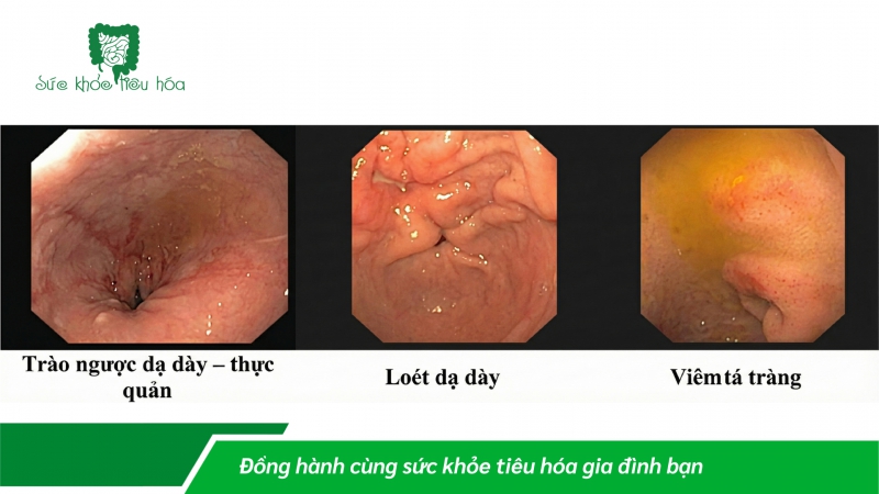 Vai trò của Simethicone trong nội soi đường tiêu hóa và rối loạn chức năng tiêu hóa