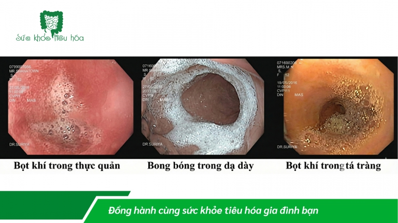 Vai trò của Simethicone trong nội soi đường tiêu hóa và rối loạn chức năng tiêu hóa