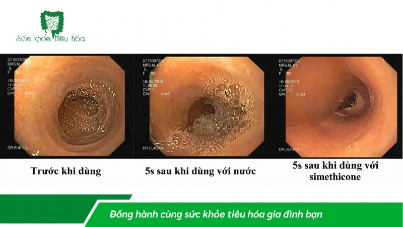 Vai trò của Simethicone trong nội soi đường tiêu hóa và rối loạn chức năng tiêu hóa