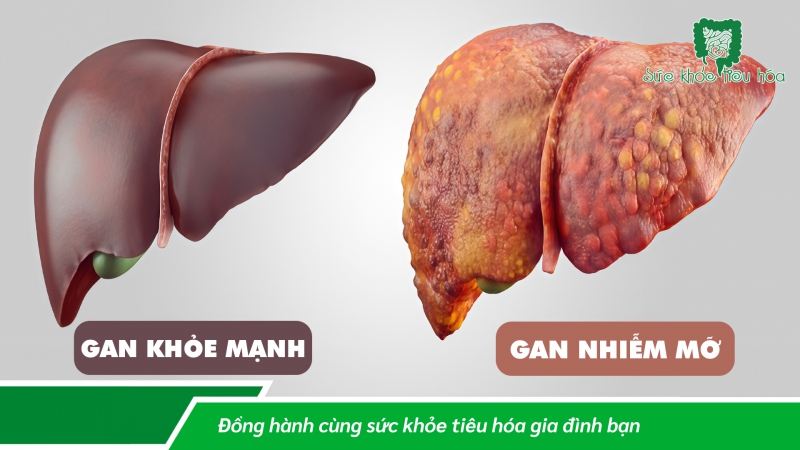 HIỆU QUẢ CỦA MEN VI SINH PROBIOTICS ĐỐI VỚI BỆNH GAN NHIỄM MỠ KHÔNG DO RƯỢU