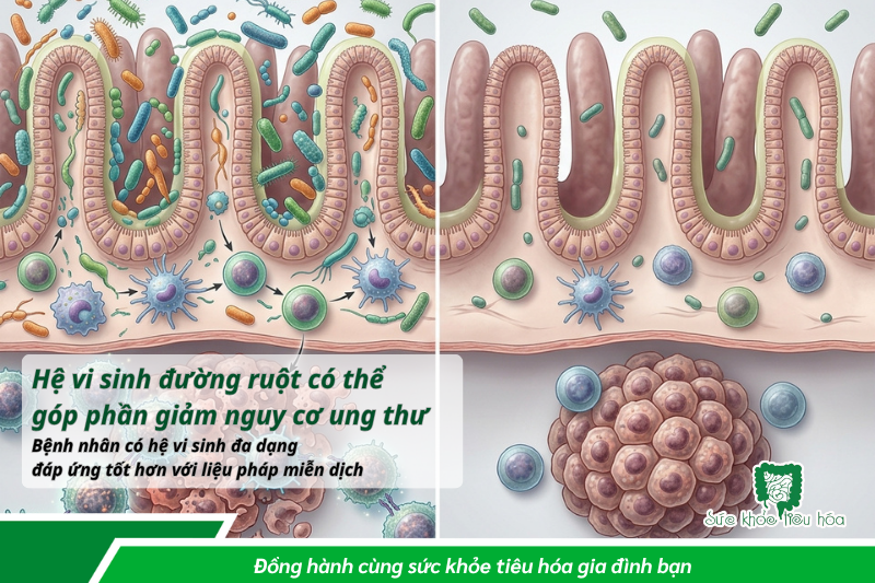 HÀNG NGHÌN TỶ VI KHUẨN TRONG RUỘT BẠN ĐANG GÓP PHẦN GIẢM NGUY CƠ UNG THƯ?