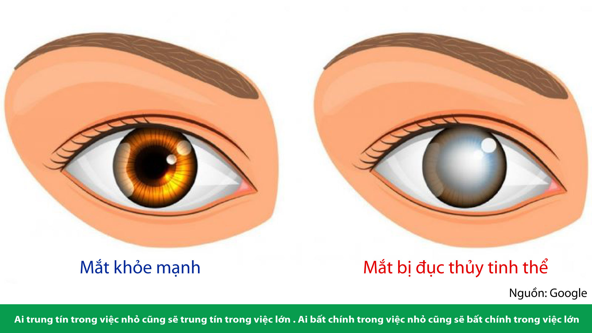 BỆNH ĐỤC THỦY TINH THỂ MẮT (CATARACTE)