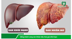 HIỆU QUẢ CỦA MEN VI SINH PROBIOTICS ĐỐI VỚI BỆNH GAN NHIỄM MỠ KHÔNG DO RƯỢU
